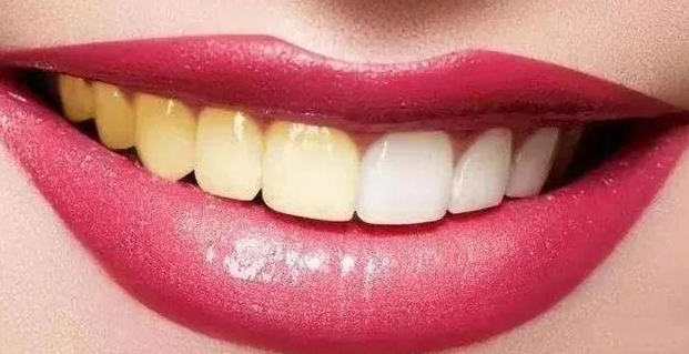 大连自然美白牙齿的方法有哪些？ 